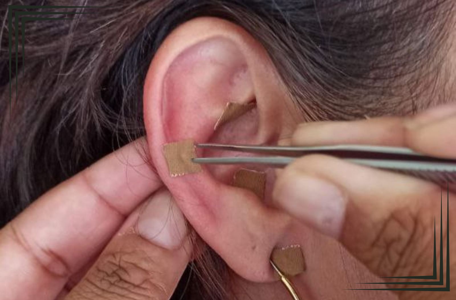 Auriculoterapia